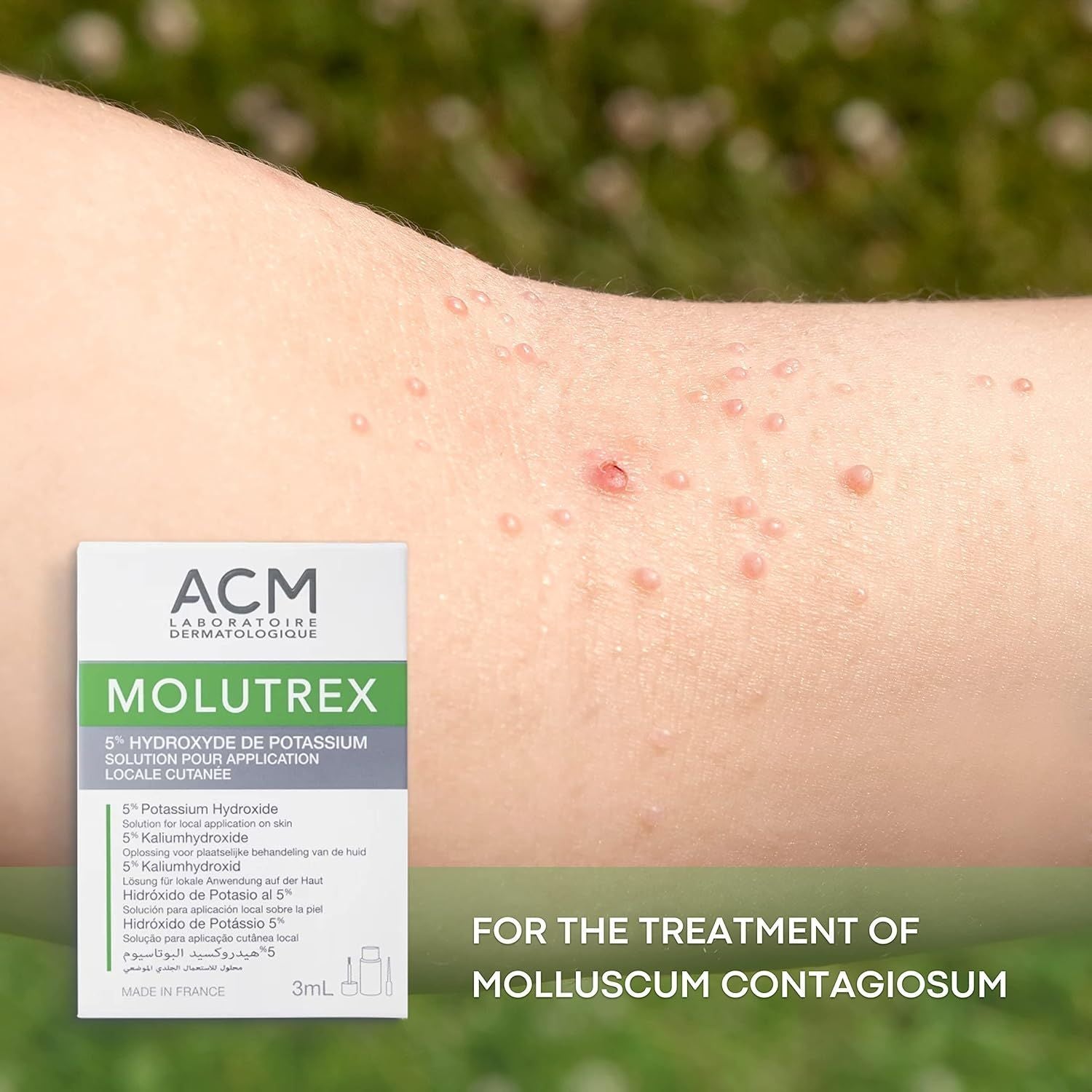 Acm Molutrex 5% Potassium Hydroxide, 3ml - Makkah Pharmacy